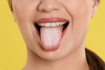 Young woman showing tongue with white patches on yellow background, closeup. Oral candidiasis (thrush) disease - obrazy, fototapety, plakaty