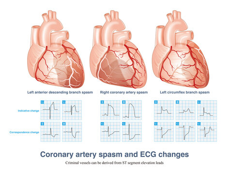 Coronary artery spasm causes transmural myocardial ischemia, and ST segment elevation in ECG has localization characteristics. Criminal vessels can be derived from ST segment elevation leads in ECG.