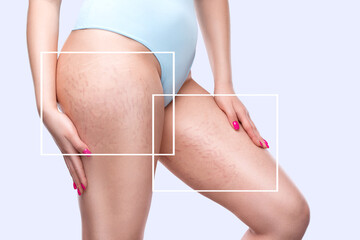 A woman after weight loss shows stretch marks on the skin of her legs and the outer and inner side of the thighs. Treatment of skin stretch marks in the clinic.