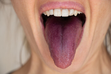 Red tongue after mulberry, open mouth and tongue of a girl close up - obrazy, fototapety, plakaty