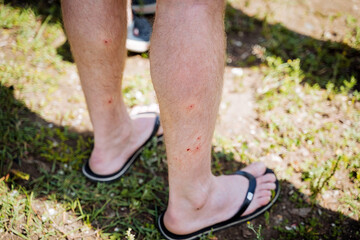 Red dots on human legs, bites of small blood-sucking insects, damage to the skin, itching and irritation of blisters, midge bite, pain in the legs. - obrazy, fototapety, plakaty
