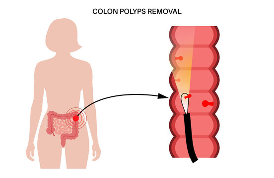 Colon Polyps Inflammation