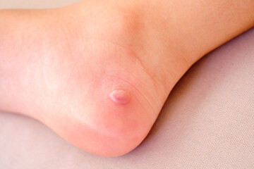 blister on the heel of a girl