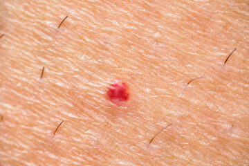 super macro of red angioma on the skin