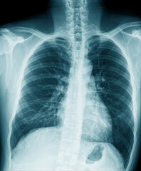 chest x-ray image in blue tone