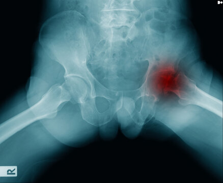 hip fracture at intertrochanteric