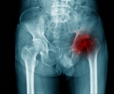 hip fracture at intertrochanteric