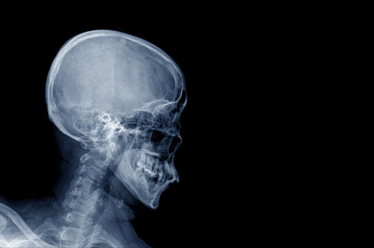 x ray human skull on black background