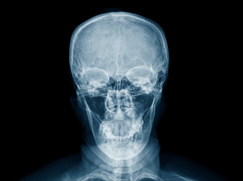x ray human skull on black