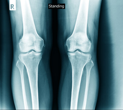 knee joint x ray degeneration