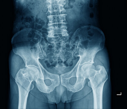 human pelvic bone x ray
