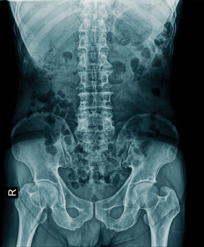 x-ray image of lumbo sacral