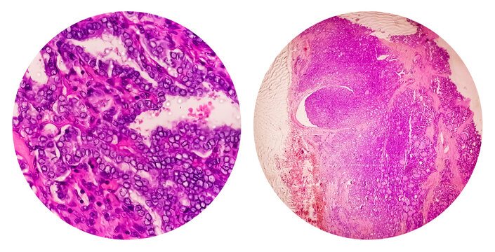 Photo collage of microscopic image showing Papillary thyroid carcinoma.