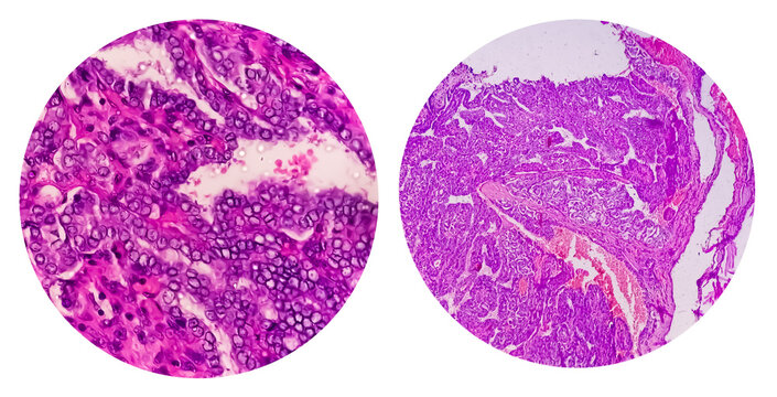 Photo collage of microscopic image showing Papillary thyroid carcinoma.
