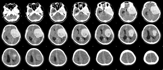 CT Brain History Headache Finding a 7 cm. extra-axial mass with stong enhancement and mass effect to left cerebral hemisphere,meningioma,Medical image concept.