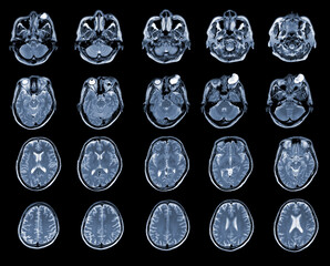 MRI OF BRAIN AND ORBIT Finding A well-defined, cystic lesion with internal papillary projection at the medial aspect, occupying at intra and extra-conal compartments of left orbit.Medical concept.