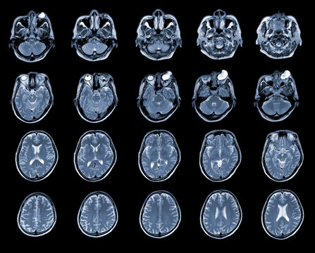 MRI OF BRAIN AND ORBIT Finding A well-defined, cystic lesion with internal papillary projection at the medial aspect, occupying at intra and extra-conal compartments of left orbit.Medical concept.