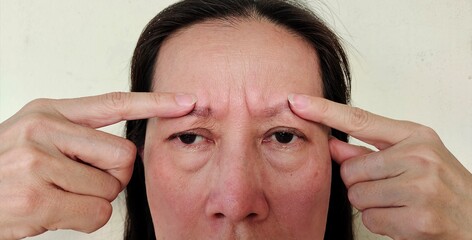 Portrait showing the fingers holding the flabbiness and forehead lines on the face, problem wrinkle and dark spots under the eyes of the woman, concept health care.