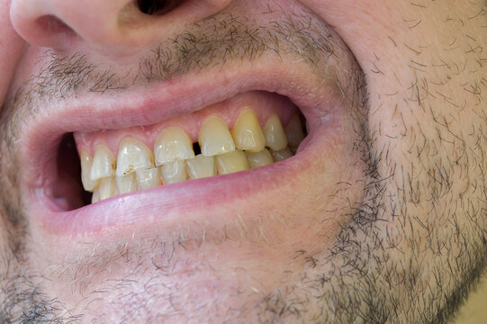 Teeth with plaque and caries of a man.