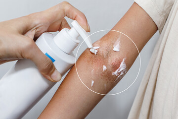 Children's atopic skin, moisturizing the skin with emollient cream, atopic dermatitis - obrazy, fototapety, plakaty