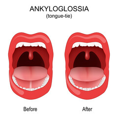 Ankyloglossia. tongue-tie. congenital oral anomaly