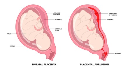 vasa previa and fetal infant baby born c section nuchal cord twins fetus defect vessels funic labor growth low lying birth fluid of PROM test increta cervix Bilobed sac uterus neck knotted Contraction