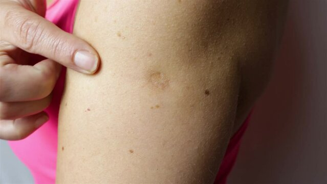 A scar from a smallpox vaccination is visible on an mature woman upper arm