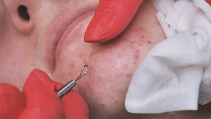 Squeezing acne from a girl with problem skin in the salon using a loop.