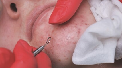 Squeezing acne from a girl with problem skin in the salon using a loop.