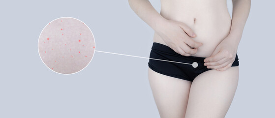 Irritation of the skin of the bikini area. consequences of depilation. Skin injuries. Pimples and...