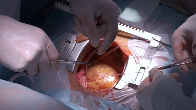 Closeup of professional doctor hands operating a patient during open heart surgery in surgical room