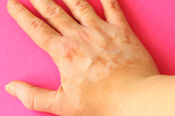 women hand with vitiligo skin