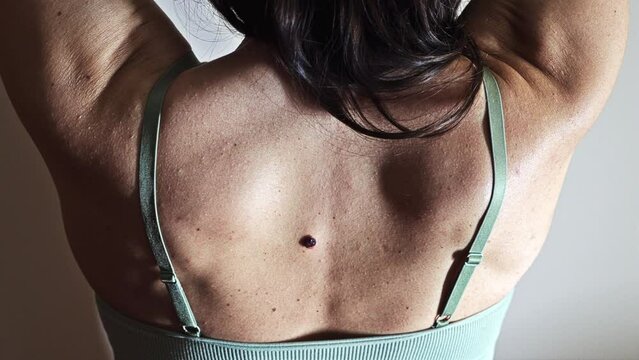A visit to a dermatologist, showing problematic back skin with a birthmark or Seborrheic keratosis.