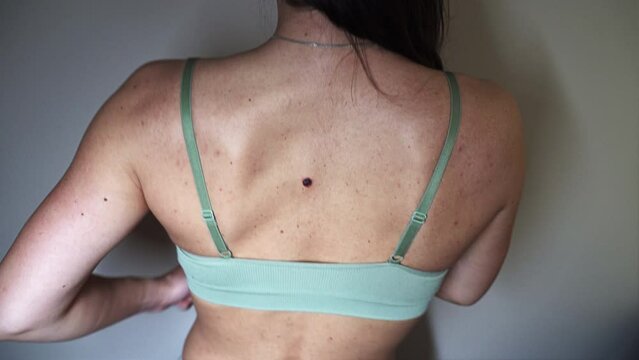 A woman dancing and celebrating her problematic skin with a mole. View from the back.