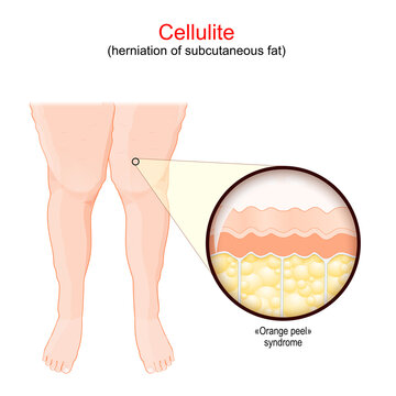 Cellulite. Females legs. human skin with Orange peel syndrome.