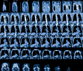 Magnetic Resonance Image (MRI) of chest organs