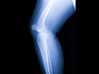x-ray image of both knee, human's knee joints