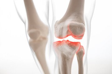 Medically accurate representation of an arthritic knee joint, knee meniscus, human leg