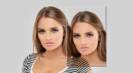 Acne,Skin concern,blemish-prone skin and acne, Rosacea,different types of acne