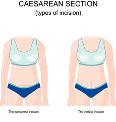 caesarean section. types of incision.
