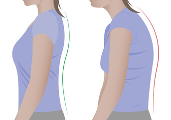 Illustration of a woman's back with a healthy spine and with scoliosis, a bent spine. Vector - obrazy, fototapety, plakaty