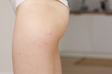 skin allergies, hips skin women. Closeup of red pustules on a hips, an allergic reaction caused by...