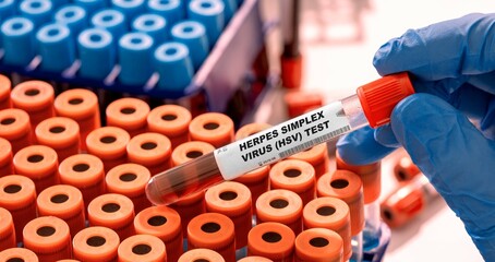 Herpes Simplex Virus (HSV) Test tube with blood sample in infection lab