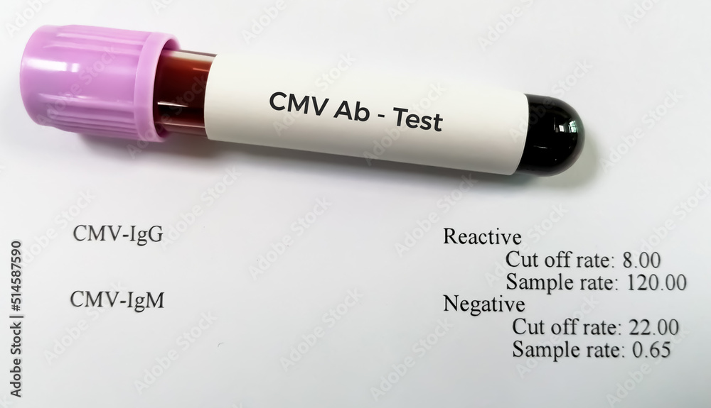 Sticker blood sample tube for cytomegalovirus (cmv) antibody testing with abnormal patient report.