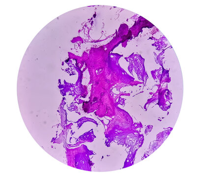 Enchondroma: Benign bone tumor. Microscopic image of enchondroma.