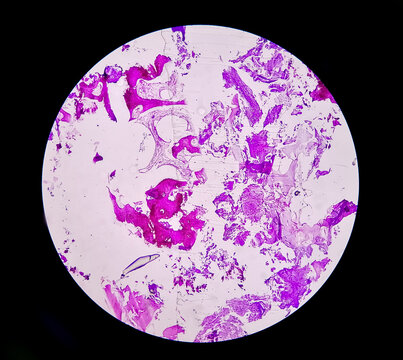 Enchondroma: Benign bone tumor. Microscopic image of enchondroma.