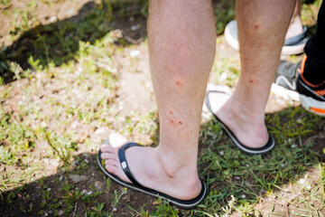 The tourist stands in flip-flops, human legs bitten by a midge, traces of mosquito bites, sore legs, foci of skin irritation.