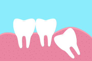 Illustration of wisdom tooth.Dental concept