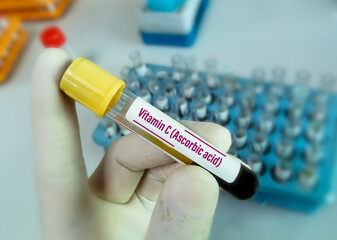 Blood sample for vitamin C (ascorbic acid) test.