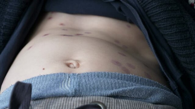 Close-up Kid Belly Chest Body Covered with Rash of Itchy Inflamed Blisters. Chickenpox Infected Boy. Child Disease. 2x Slow motion 60fps 4K